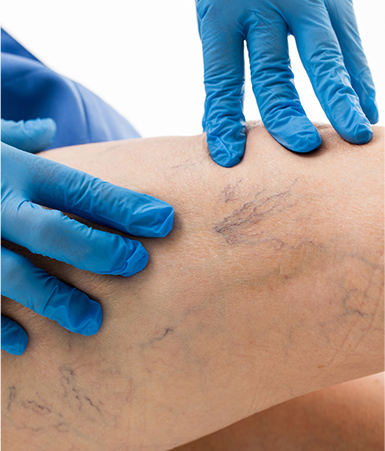 VARICOSE VEINS